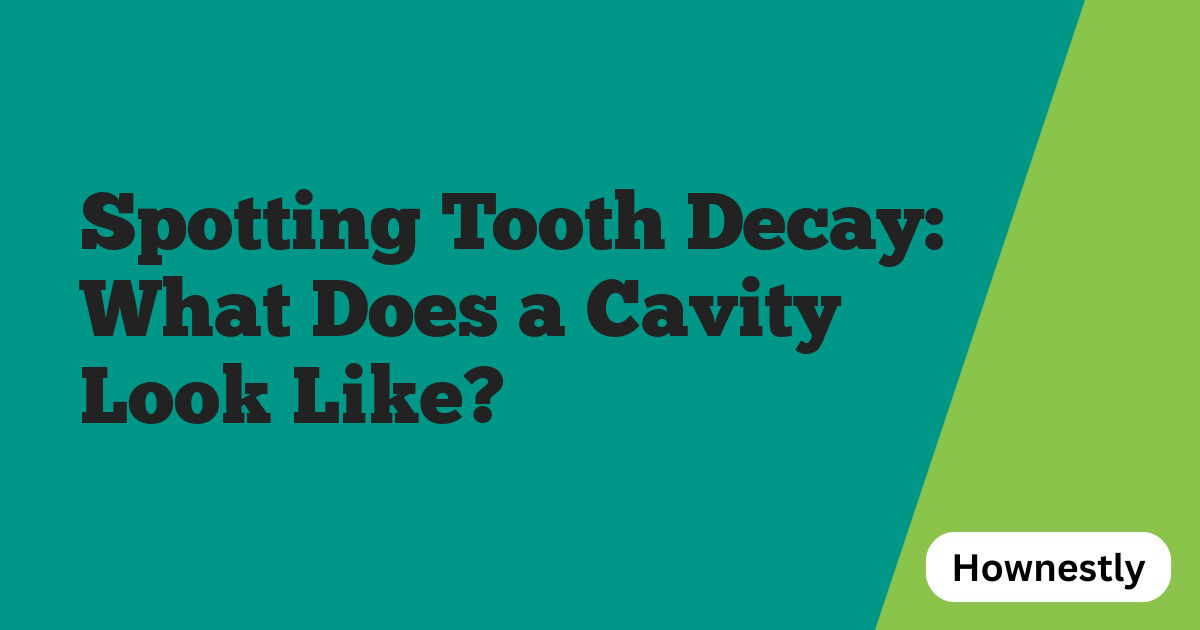 Spotting Tooth Decay: What Does a Cavity Look Like?